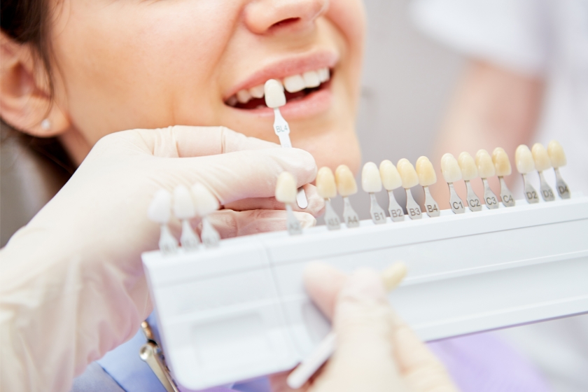 Tooth bleaching